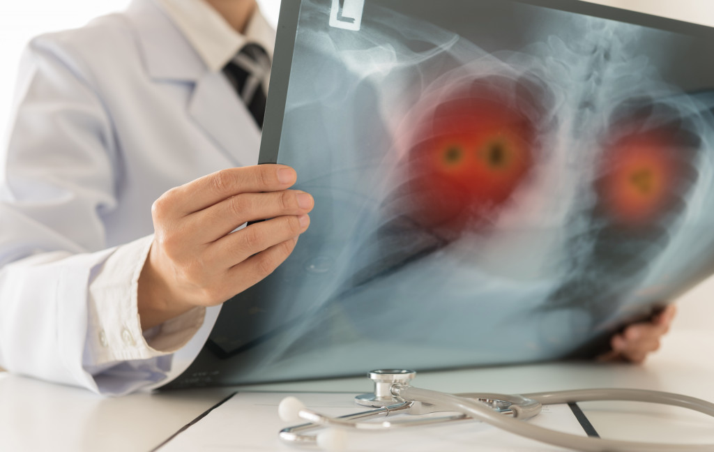 doctor looking at xray concept of lung cancer